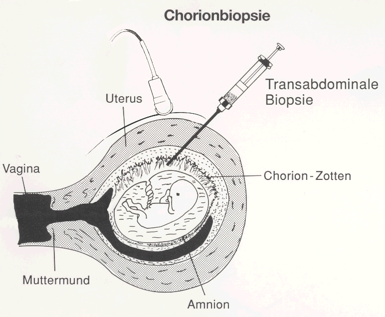 chorionzottenbiopsie